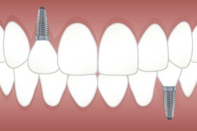 entretien implant dentaire villejuif